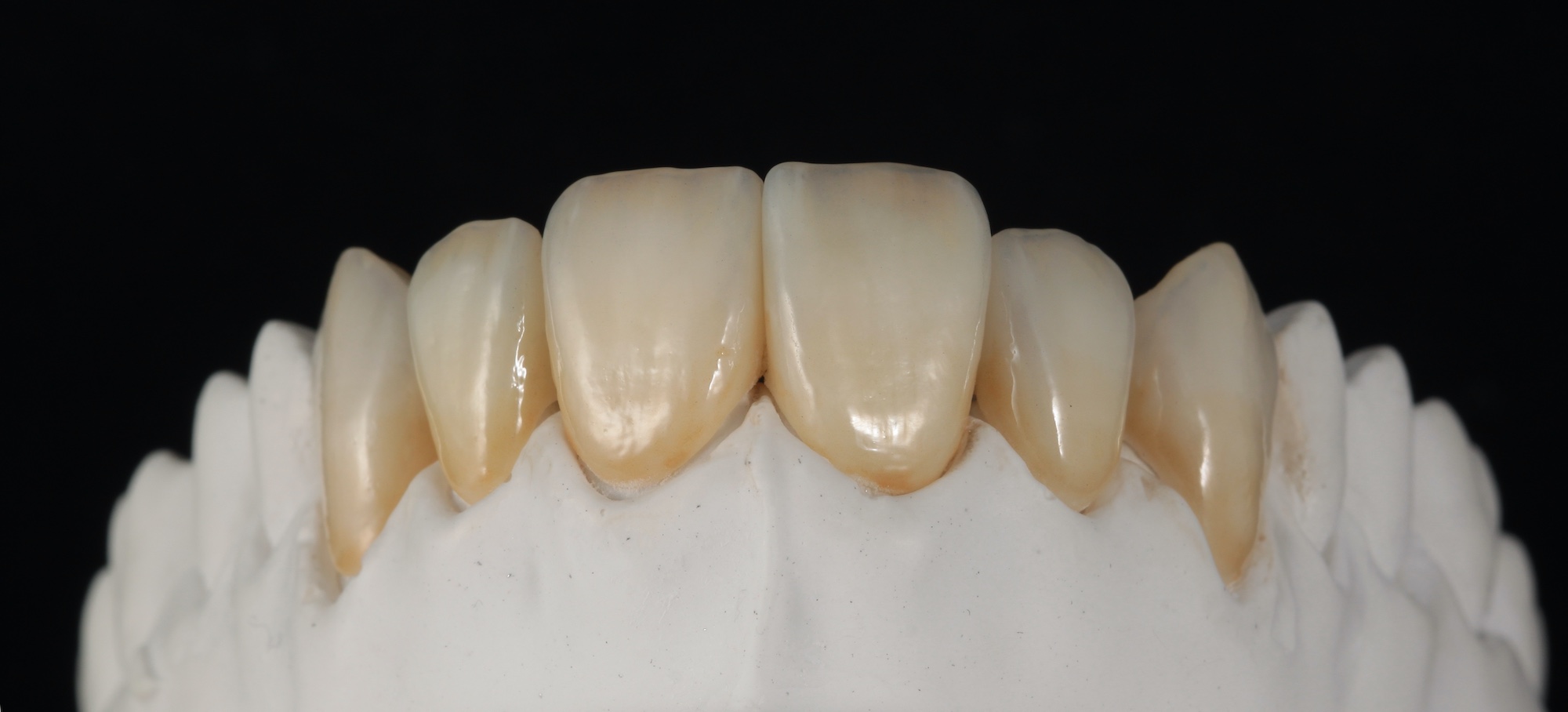 Zircon crownsmonolithic Dental Inpuls